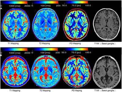 Prediction of brain age using quantitative parameters of synthetic magnetic resonance imaging